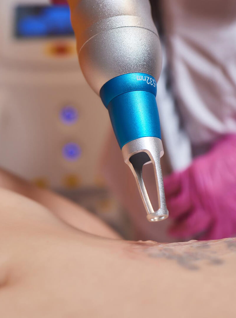 CQ-MED-SPA-tatoo-removal